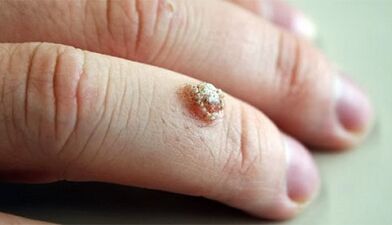 Métodos para o tratamento das verrugas con celandina