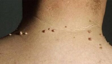 As razóns para a aparición de papilomas no corpo humano