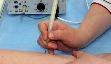 Como desfacerse dos papilomas no teu corpo