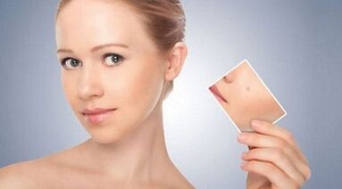 Revisión de remedios eficaces para verrugas e papilomas