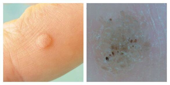 Verrugas comúns durante o exame e a dermatoscopia