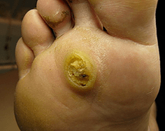 Papillomas subanarios